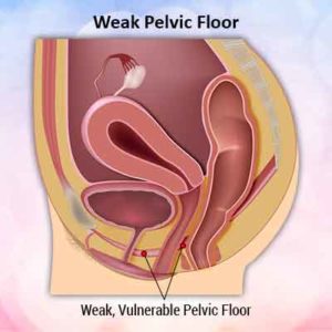weak pelvic floor min 1 300x300 Weak pelvic floor